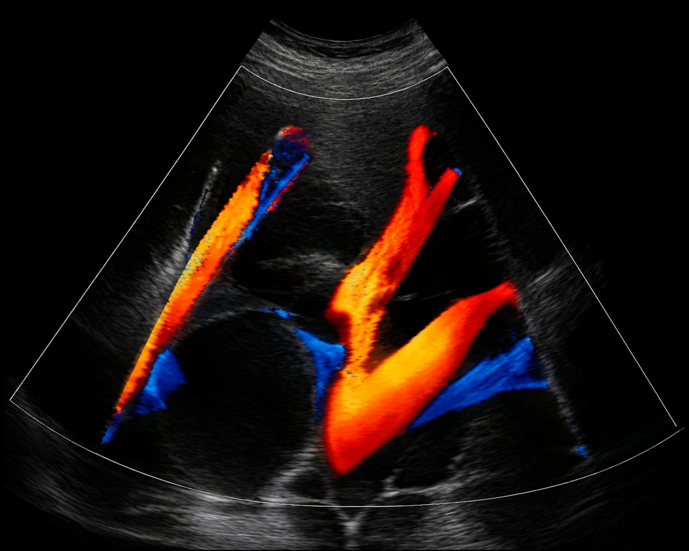Colour Doppler