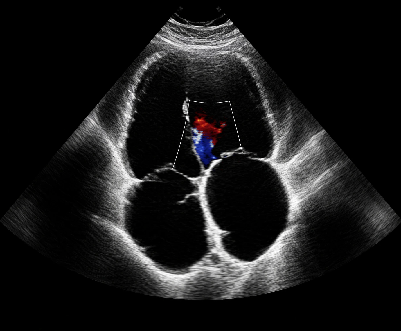 2D Echocardiography
